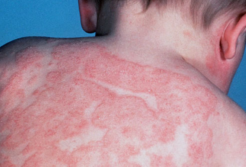 Dermatitis atopica alimentacion sana